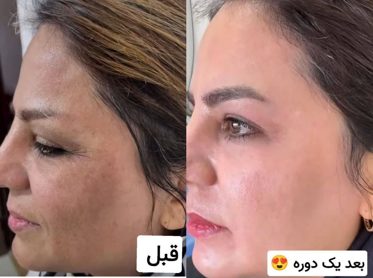 کرم روز گاتیو حاوی هیالورونیک اسید و ابرسانی عمیق پوست--اصل ایتالیا مناسب انواع پوست
