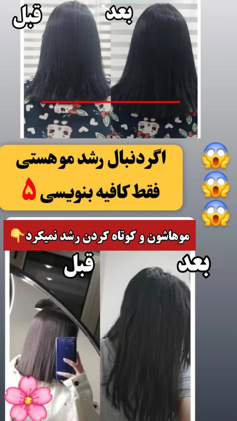تونیک ضد ریزش و و رویش مجدد مو دوقلو برند اکسونیک درمان ریزش سکه ای مو-معجزه قرن تحت لیسانس المان مستقیم از نمایندگی ایران زمین