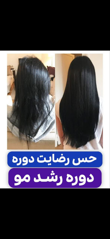 تونیک ضد ریزش و و رویش مجدد مو دوقلو برند اکسونیک درمان ریزش سکه ای مو-معجزه قرن تحت لیسانس المان مستقیم از نمایندگی ایران زمین