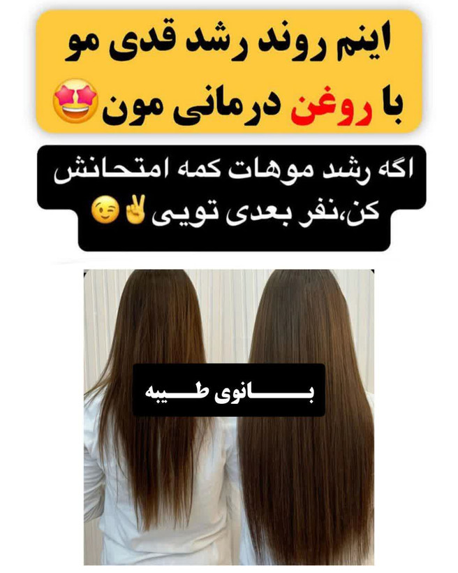تونیک ضد ریزش و و رویش مجدد مو دوقلو برند اکسونیک درمان ریزش سکه ای مو-معجزه قرن تحت لیسانس المان مستقیم از نمایندگی ایران زمین