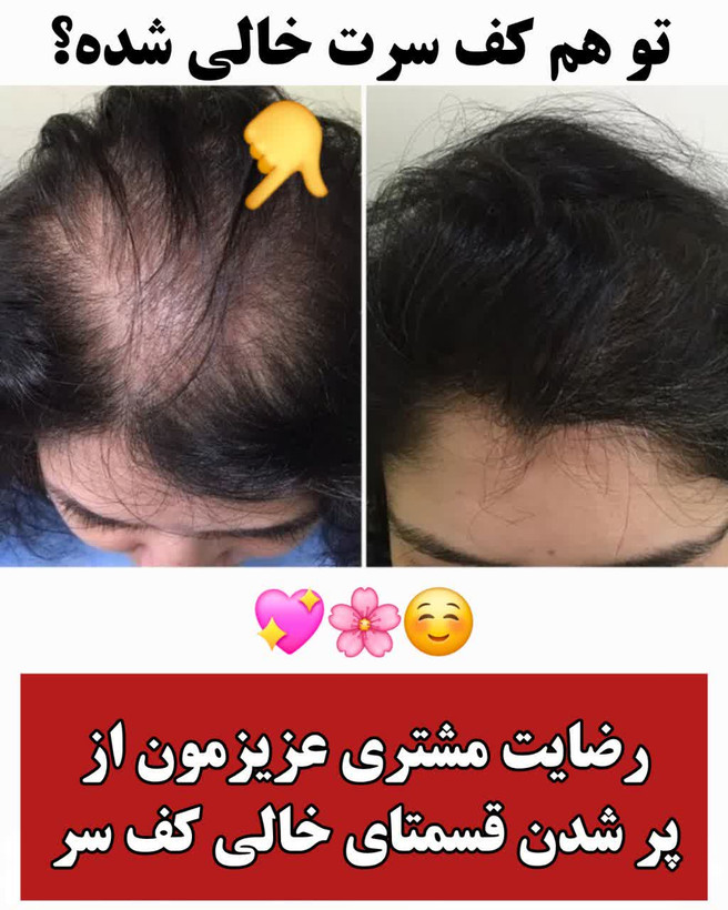 تونیک ضد ریزش و و رویش مجدد مو دوقلو برند اکسونیک درمان ریزش سکه ای مو-معجزه قرن تحت لیسانس المان مستقیم از نمایندگی ایران زمین