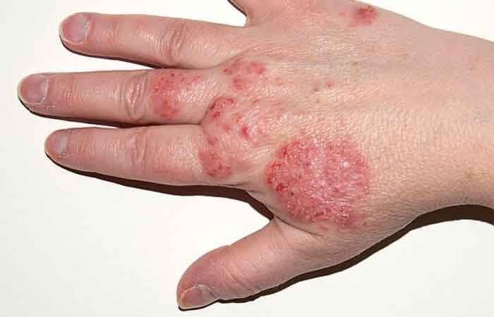 کرم بیوممتیک (چندکاره)برند معروف vitabellaa درمان اگزما و پسوریازیس و خشکی پوست